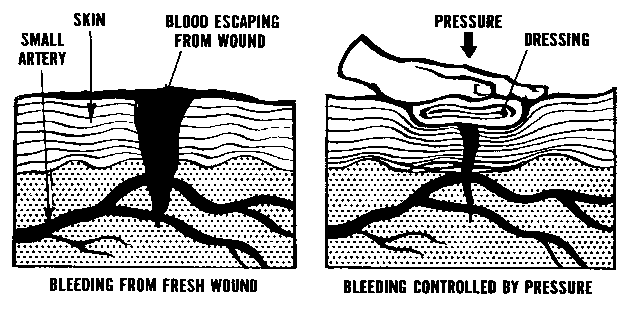 Controlling bleeding